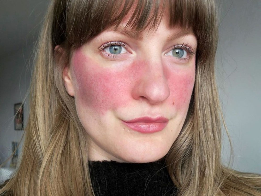 Cuidados da pele com Rosácea 2 rosacea Cuidados da pele com Rosácea