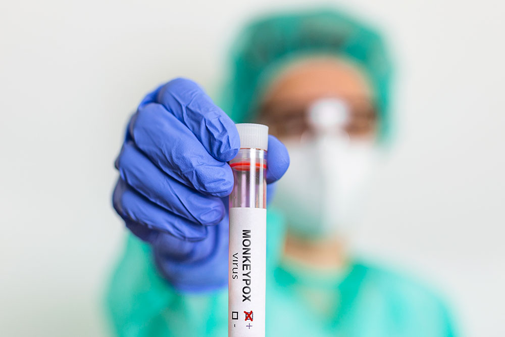 Primeiro caso de Monkeypox é registrado na cidade de Pinhais 7 pinhais Primeiro caso de Monkeypox é registrado na cidade de Pinhais