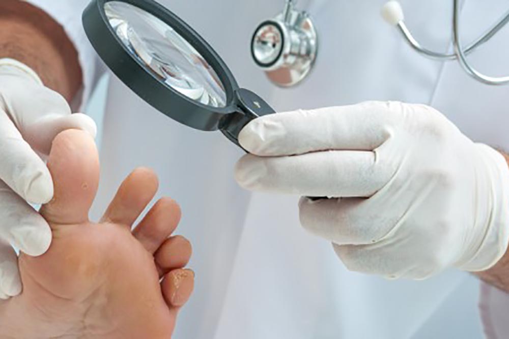 Dermatologista revela quais doenças da pele são mais comuns no verão 3 micoses Dermatologista revela quais doenças da pele são mais comuns no verão