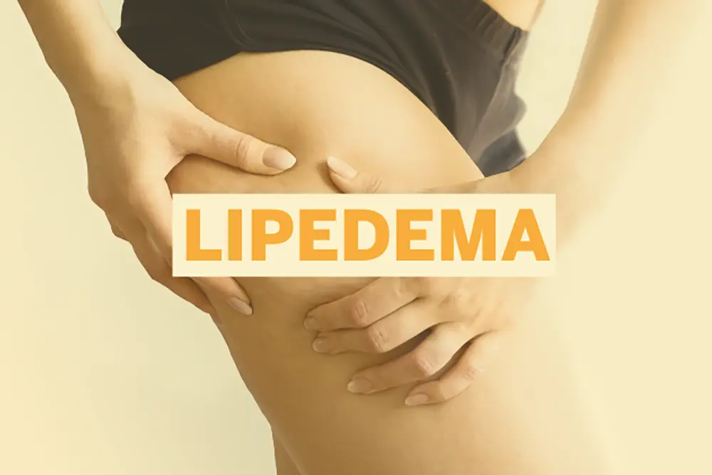 Lipedema: mais de 10 milhões de brasileiras podem ter a doença e não sabem 1 Lipedema