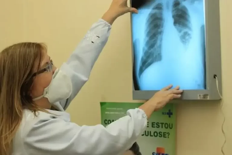 tuberculose