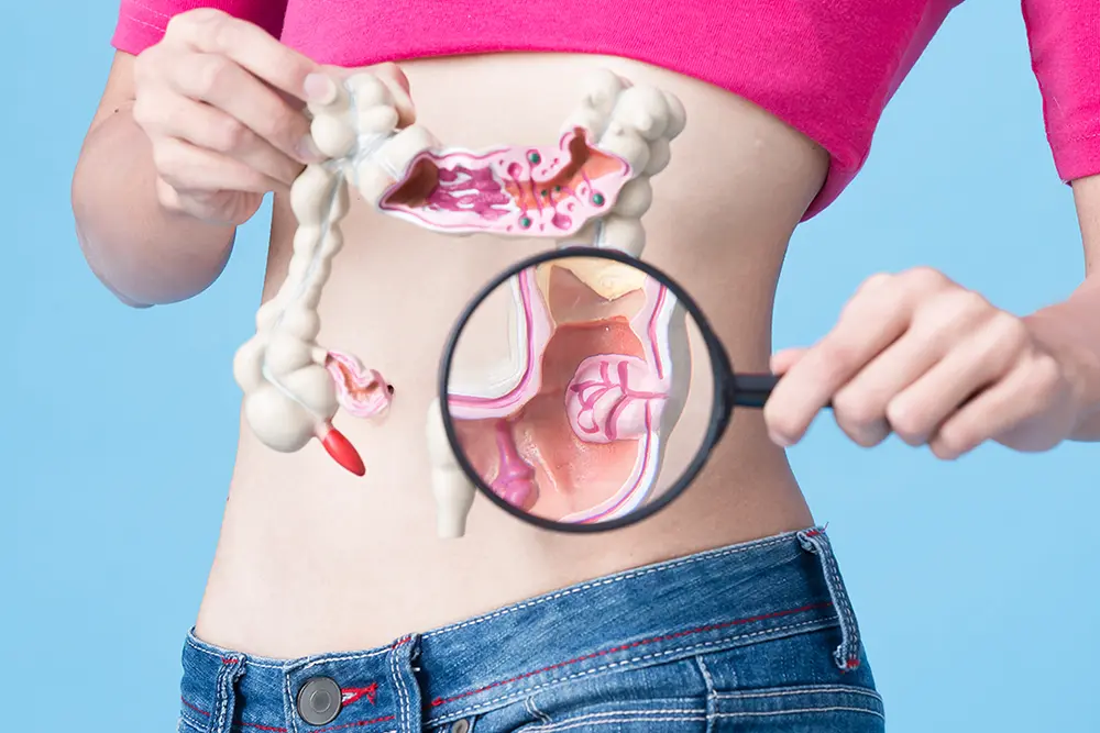 Alerta: câncer colorretal avança entre os jovens 2 câncer colorretal