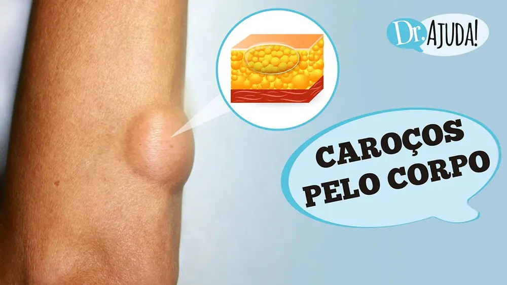 Caroços pelo corpo e lipoma: O que são? O que reparar? 8 https://youtu.be/QeA1VLCQ5qs