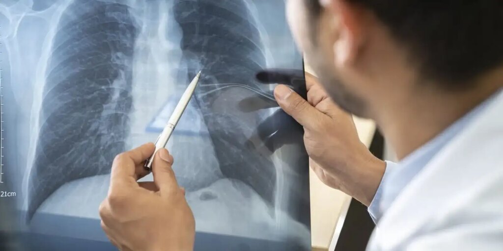 estagios cancer de pulmao Jovens de 16 a 24 Anos: Aumento Preocupante no Tabagismo