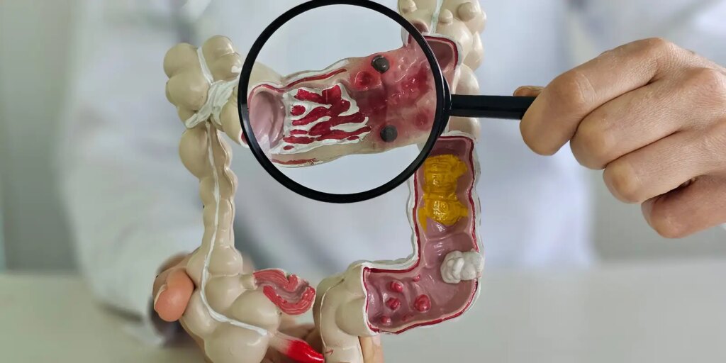 Doença Inflamatória Intestinal: Crescimento e impacto no Brasil 8 adobestock 1773729270 Doença Inflamatória Intestinal: Crescimento e impacto no Brasil